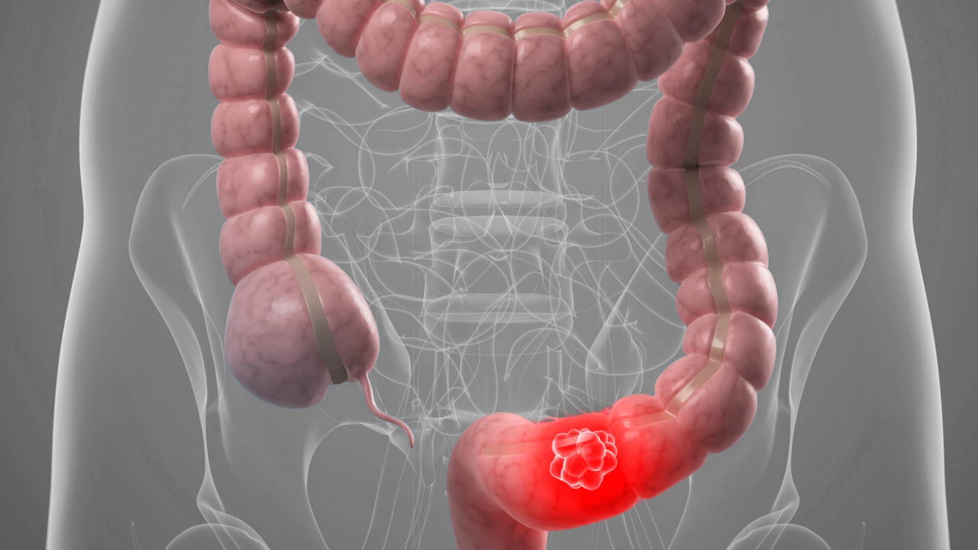 Colorectal cancer research